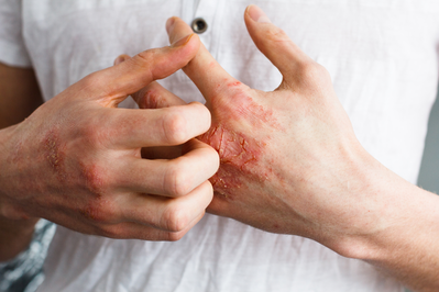 psoriasis on hands