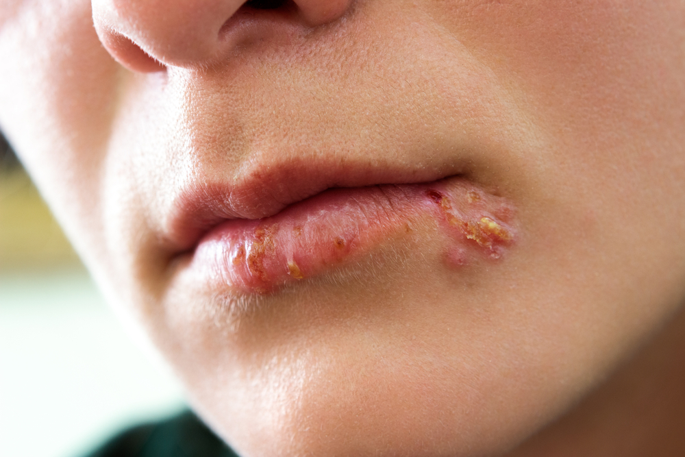 woman with cold sores on her lips