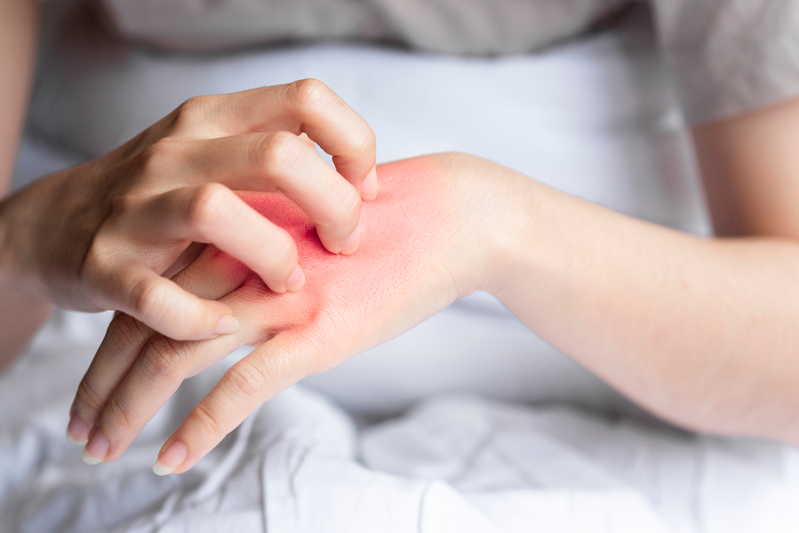 woman scratching rash on hand