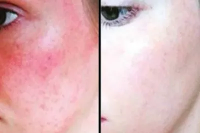 Rosacea