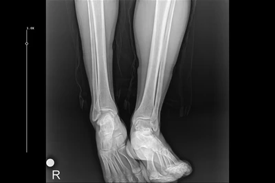 x ray of legs
